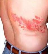 Characteristic rash of Herpes Zoster on the thorax