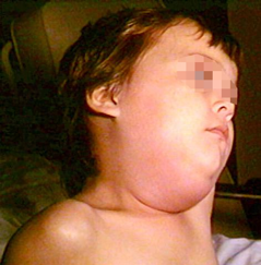 Photo 1: Parotid swelling typical of mumps
