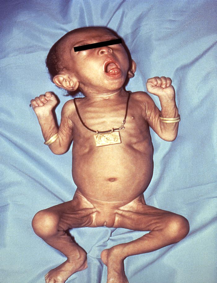 Photo1: Coughing fit in infant with pertussis. (Source: Centers for Disease Control and Prevention)