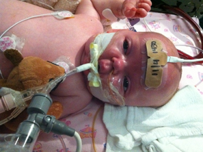 Photo 2: Infant in treatment for severe case of pertussis. (Source: Centers for Disease Control and Prevention)