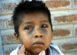 Photo 3: Child with subconjunctival hemorrhage and ecchymosis on the face caused by violent coughing. (Source: Centers for Disease Control and Prevention)